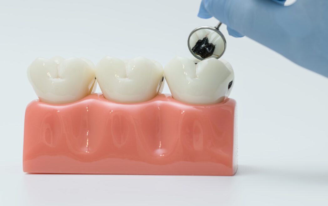 子供が虫歯になりやすい原因は？親が知るべき予防策と検診の重要性